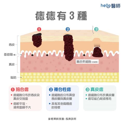 長毛痣|痣變大、痣多或長毛會變皮膚癌？認識痣的形成與原因